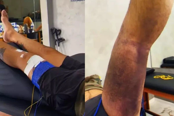 Juliana Cazarré exibe hematomas na perna por Reprodução