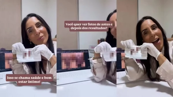 A médica que realizou a ninfoplastia em Lica Lopes, Fernanda Nassar, publicou em seu Instagram conteúdo sobre o procedimento  por Reprodução/Redes Sociais  