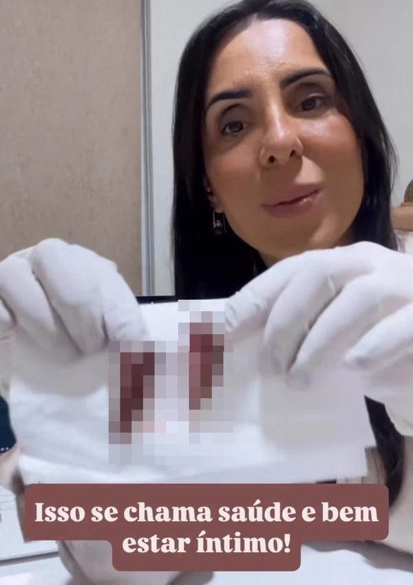 A médica que realizou a ninfoplastia em Lica Lopes, Fernanda Nassar, publicou em seu Instagram conteúdo sobre o procedimento  por Reprodução/Redes Sociais   