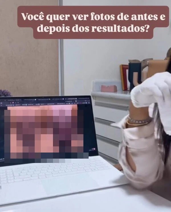 A médica que realizou a ninfoplastia em Lica Lopes, Fernanda Nassar, publicou em seu Instagram conteúdo sobre o procedimento  por Reprodução/Redes Sociais   