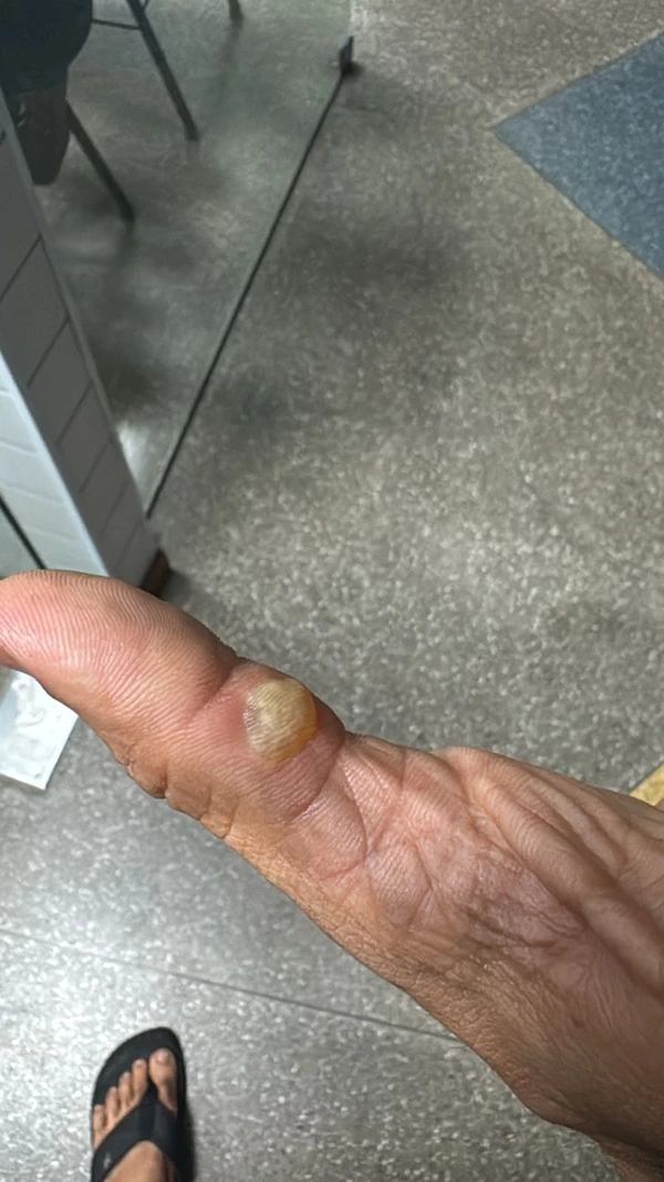 Dono do estabelecimento teve queimaduras por Reprodução
