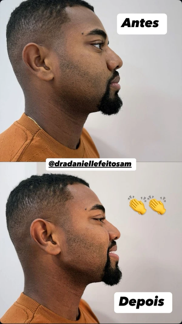 Antes e depois de harmonização na mandíbula 