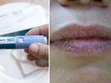 Imagem - Ozempic deixa a boca seca? Dentistas relatam sintomas bucais de pacientes