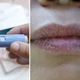 Imagem - Ozempic deixa a boca seca? Dentistas relatam sintomas bucais de pacientes