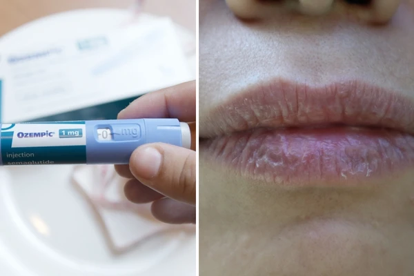Boca seca persistente (xerostomia), halitose, gosto metálico, erosão do esmalte dentários são alguns dos sintomas relatados