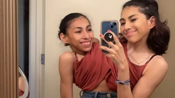 Unidas desde o nascimento, elas compartilham corpo, mas seguem sonhos distintos