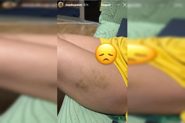 Madu Paim mostrou foto com hematomas na perna denunciando agressões de MC Estudante  por Reprodução/Redes Sociais 