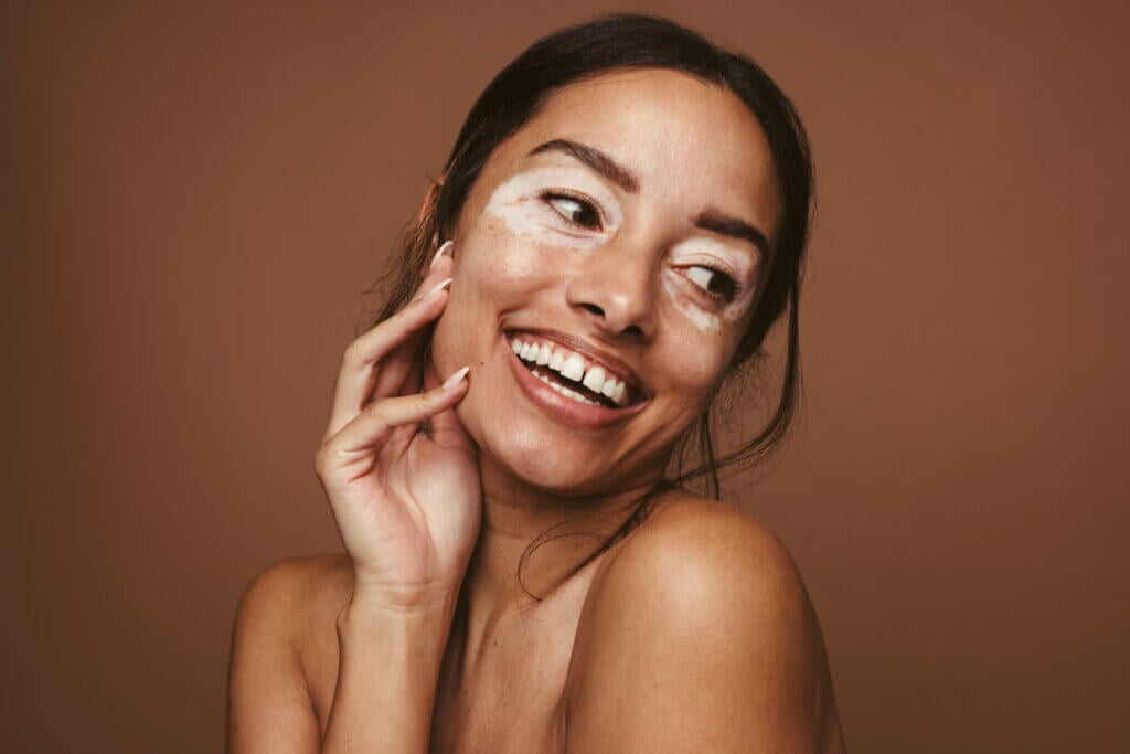 O vitiligo é uma doença que não tem formas de prevenção conhecidas (Imagem: Jacob Lund | Shutterstock)
