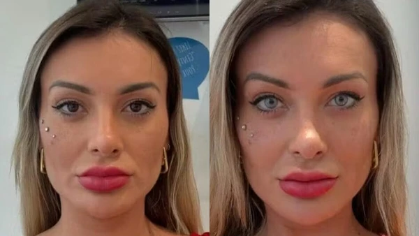 Antes e depois de Andressa Urach após cirurgia para mudança da cor dos olhos 
