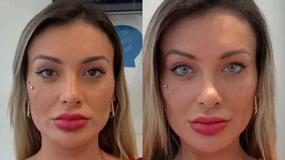 Antes e depois de Andressa Urach após cirurgia para mudança da cor dos olhos  por Reprodução/Redes Sociais 