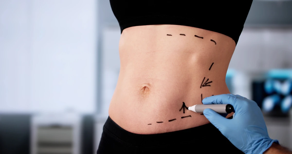 Cirurgia na região do abdômen por Shutterstock