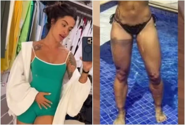 Aline Campos mostra antes e depois após remoção de tatuagem por Reprodução/Instagram