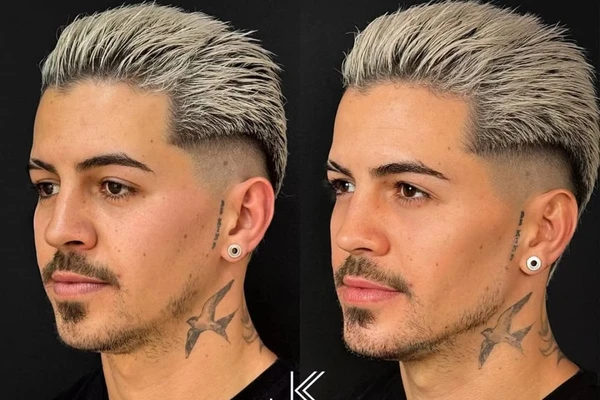Antes e depois de Biel após harmonização facial por Reprodução / Instagram