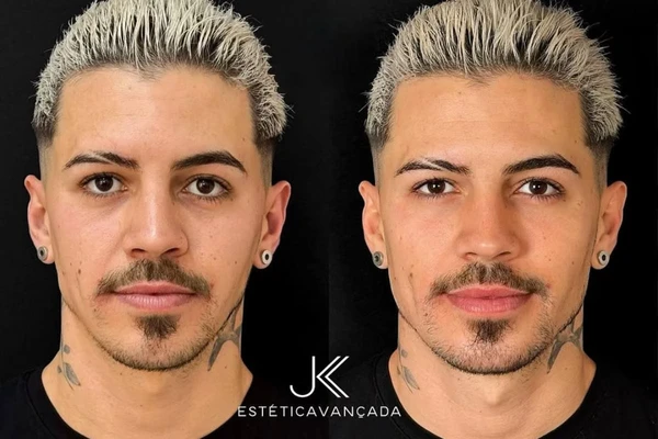 Antes e depois de Biel após harmonização facial por Reprodução / Instagram