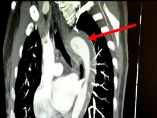 Imagem - Mulher rompe aorta durante relação sexual e é levada às pressas para cirurgia