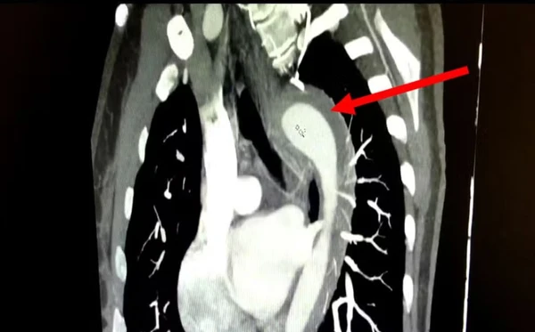 Aorta