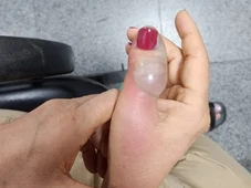 Imagem - Mulher tem infecção após fazer as unhas e passa por quatro cirurgias