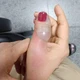 Imagem - Mulher tem infecção após fazer as unhas e passa por quatro cirurgias