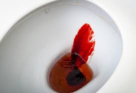 Ao primeiro sinal de sangue nas fezes, procure um médico por Reprodução