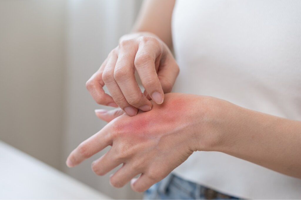 Vermelhidão e coceira na pele estão entre os sintomas comuns da forma leve de congelamento (Imagem: Kmpzzz | Shutterstock)