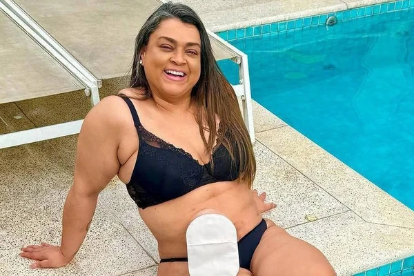 Preta Gil com bolsa de colostomia