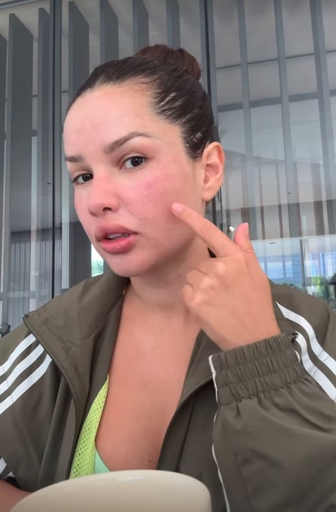 Juliette mostra inchaço no rosto após procedimento estético com esperma de salmão por Reprodução/Instagram
