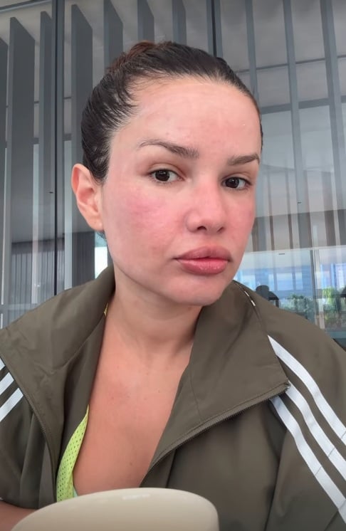 Juliette mostra inchaço no rosto após procedimento estético com esperma de salmão por Reprodução/Instagram