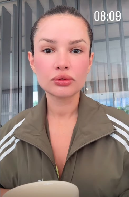 Juliette mostra inchaço no rosto após procedimento estético com esperma de salmão por Reprodução/Instagram