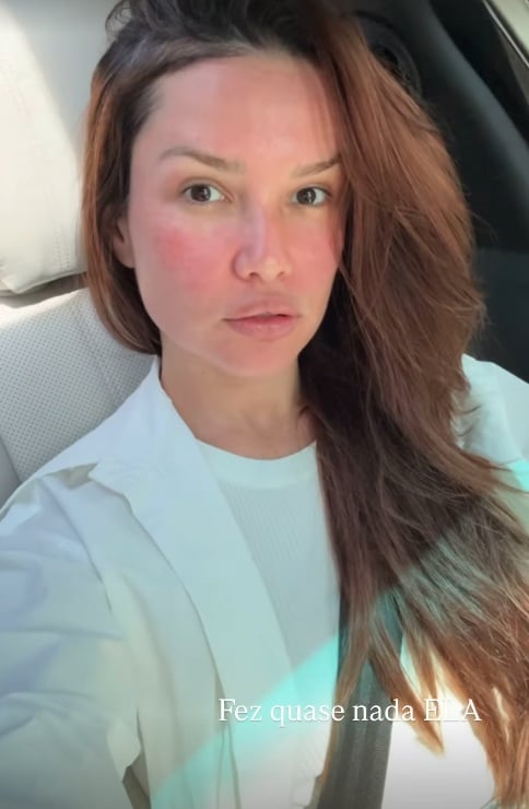 Juliette mostra inchaço no rosto após procedimento estético com esperma de salmão por Reprodução/Instagram