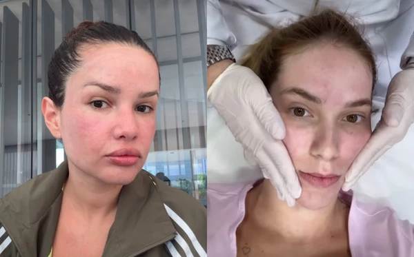 Juliette e Virgínia já passaram pelo procedimento