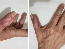 Imagem - Mulher perde parte do dedo ao contrair infecção após fazer a unha em salão de beleza; veja riscos