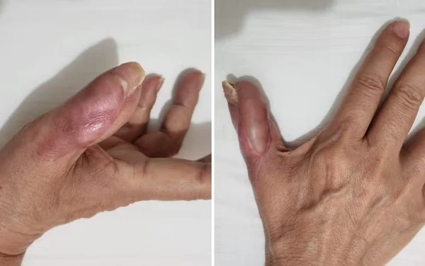 Mulher perde parte do dedo ao contrair uma infecção após fazer a unha em salão de beleza