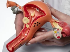 Imagem - Endometriose: nova forma de diagnóstico promete alívio financeiro e diagnóstico rápido