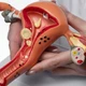 Imagem - Endometriose: nova forma de diagnóstico promete alívio financeiro e diagnóstico rápido