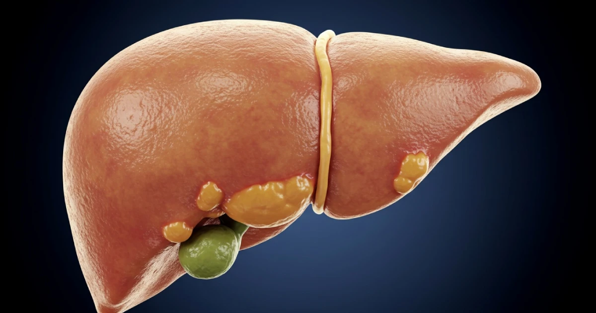 Imagem - Gordura no fígado pode causar câncer e levar à morte; veja sintomas, causas e como prevenir