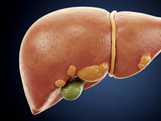 Imagem - Gordura no fígado pode causar câncer e levar à morte; veja sintomas, causas e como prevenir
