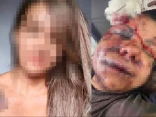 Imagem - Mulher que levou mais de 60 socos do namorado vai passar por cirurgia para reconstruir ossos do rosto