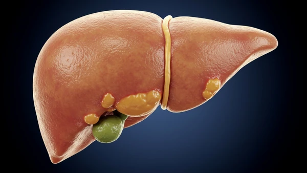 Estudo aponta ligação entre gordura no fígado e maior risco de diabetes tipo 2