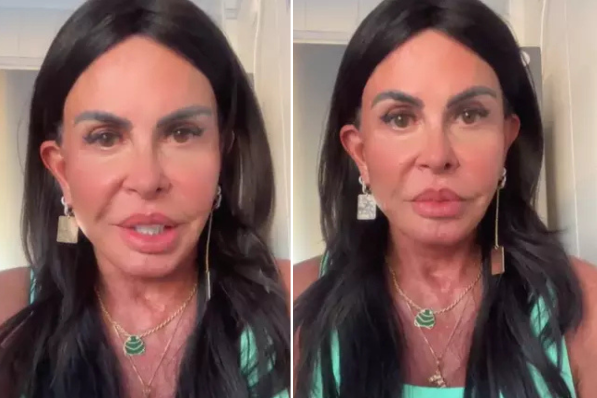 Gretchen mostra 'novo rosto' após harmonização completa por Reprodução / Redes Sociais