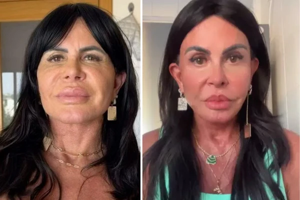 Gretchen surpreende com mudanças no rosto após nova harmonização