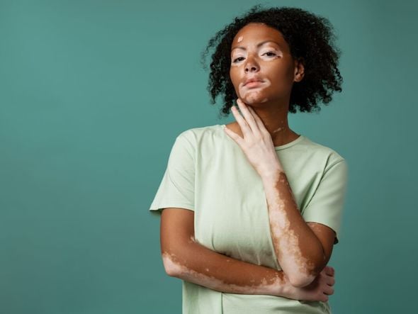 Imagem - Conheça os principais sinais do vitiligo