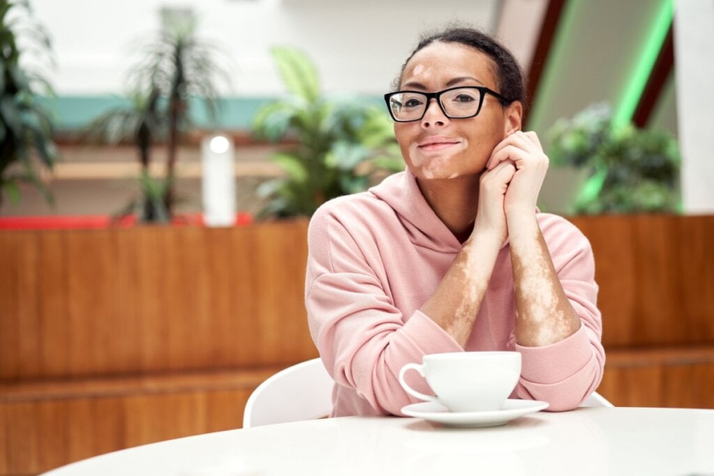 Não há formas cientificamente comprovadas de evitar o vitiligo (Imagem: andreonegin | Shutterstock)