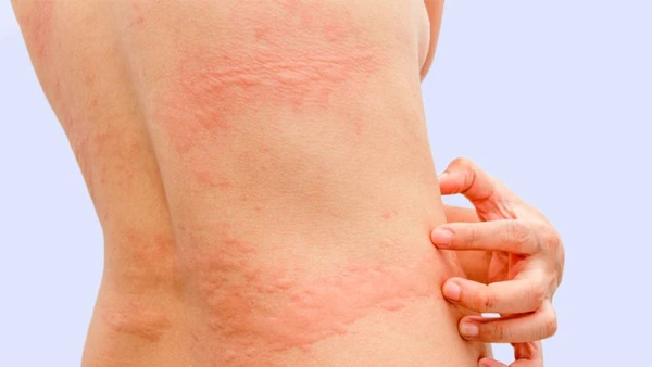 Estresse provoca série de doenças que causam manchas vermelhas na pele por Shutterstock