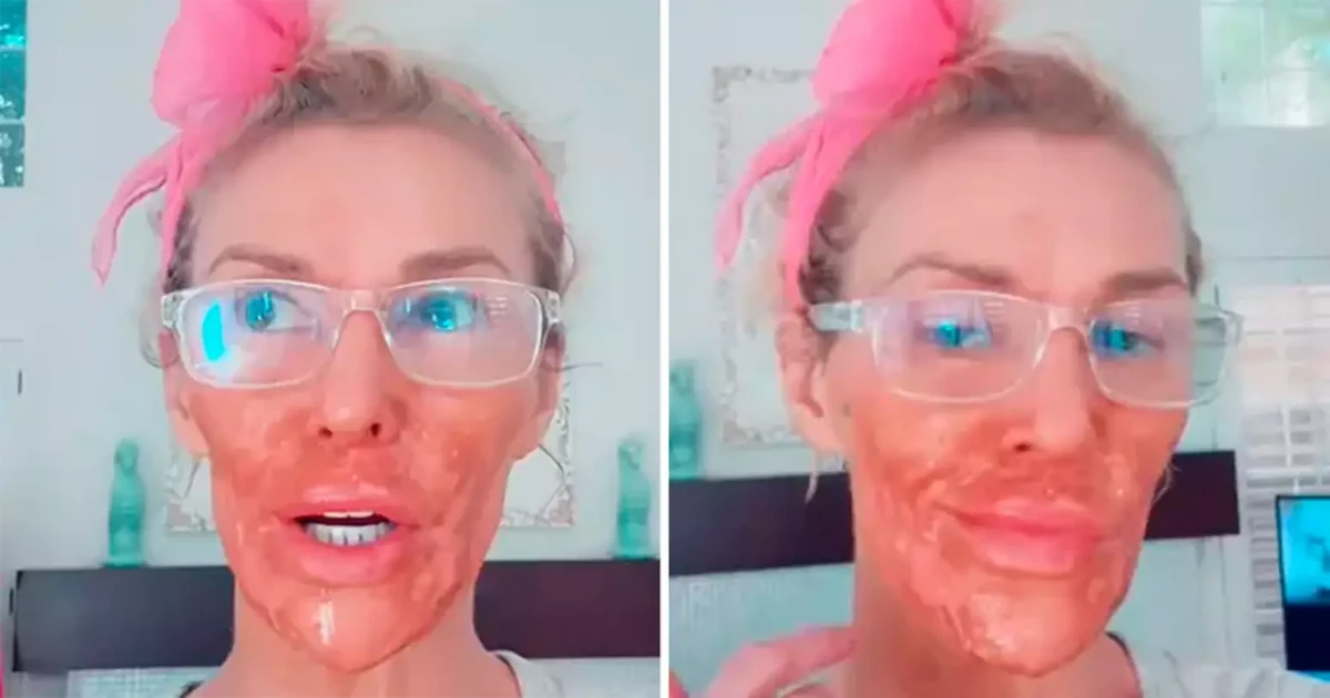 Brandi Glanville com as queimaduras por Reprodução