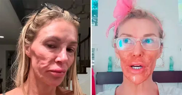 Brandi Glanville com as queimaduras por Reprodução