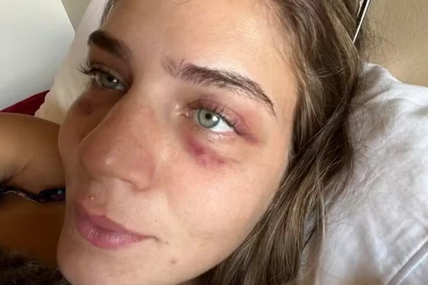 Jannah Nebbeling mostrando as marcas da suposta agressão