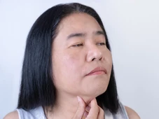 Imagem - Celulite facial: o que é, sintomas e como prevenir a infecção que pode afetar o rosto