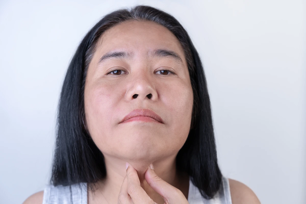 Celulite facial  por Shutterstock