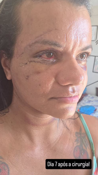 Juliana mostra resultado após cirurgia de reconstrução