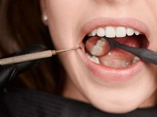 Imagem - Veja qual é a principal causa da perda de dentes em adultos,segundo a USP